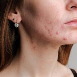 Udemy - Acne Management 2024