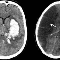 Brain Stroke - Impacts, Management, and Recovery